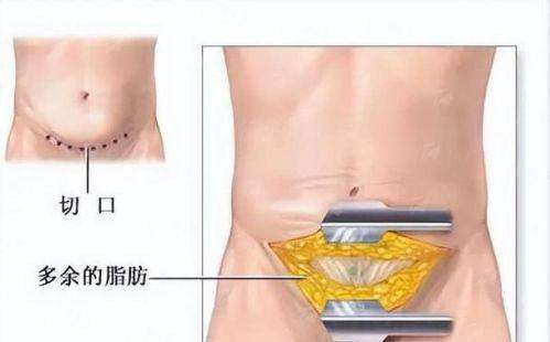 二、宋华敬腹壁成形技术有哪些特色？成都西区医生详解