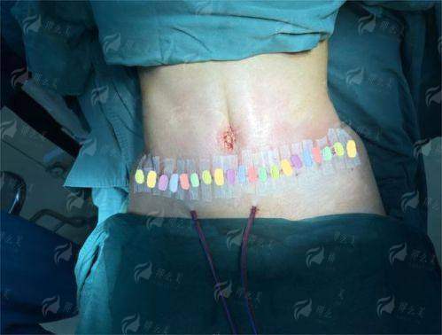 一、宋华敬腹壁成形术后修复快吗？成都西区真实实例分享