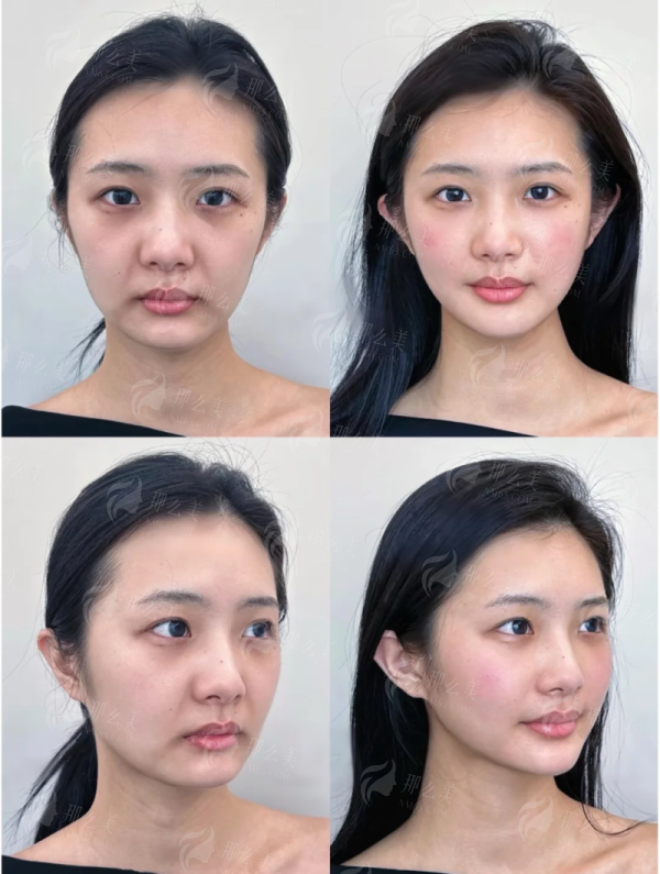 一、揭阳和美医疗冯显金医生双眼皮技术靠谱吗？