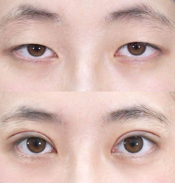 二、揭阳和美医疗冯显金医生双眼皮2026年收费贵吗？