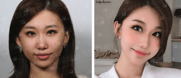 从深圳非凡医疗美容医院火出圈！张佳佳和胡志杰做双眼皮谁效果最自然？真实案例大揭秘！附预约方式