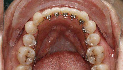 辽阳映雪口腔隐形矫正效果如何？真实患者分享+医院特色技术全揭秘！