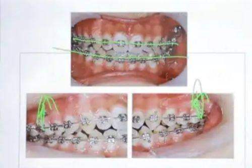 四、辽阳映雪口腔隐形矫正怎么预约更划算？