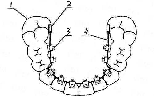 二、辽阳映雪口腔隐形矫正有哪些特殊技术？