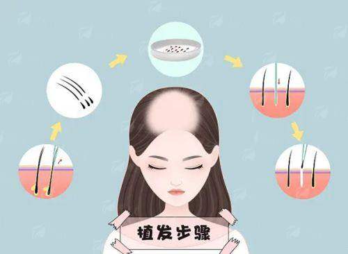 三、刘裴华医生植发价格贵不贵？郑州植发费用对比