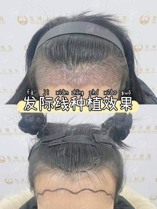 二、扬州大麦植发医生团队有哪些特色？