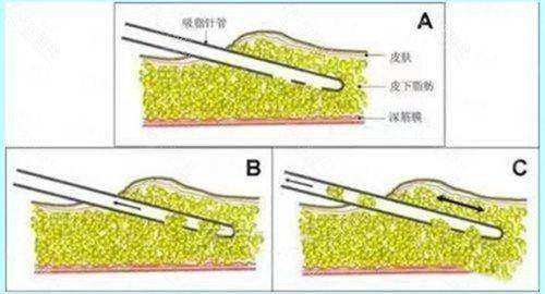 郑州芊美整形杜如意医生双眼皮预约方式+到院地址，超详细攻略！