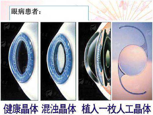 二、杜如意医生双眼皮整形有哪些独到之处?