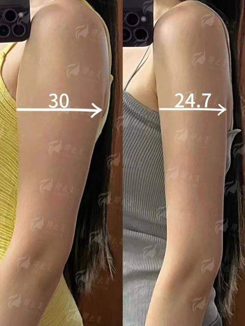 一、连云港媚眼整形手臂环吸疼不疼？医生操作细节大揭秘