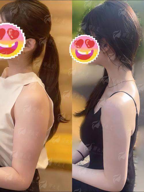 二、连云港媚眼整形手臂环吸修复期全记录