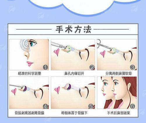 潮州星辰瑰丽假体隆鼻价格贵吗？医生技术+术后效果对比分析！