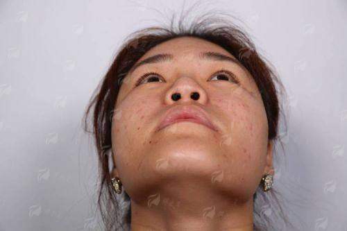 二、星辰瑰丽假体隆鼻医生技术好吗？