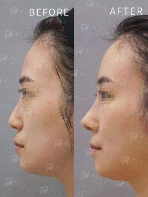 四、星辰瑰丽假体隆鼻怎么预约？术后要注意啥？