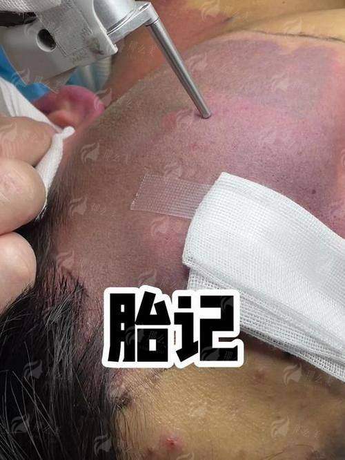 一、潮州韩美医疗美容祛胎记技术靠谱吗?