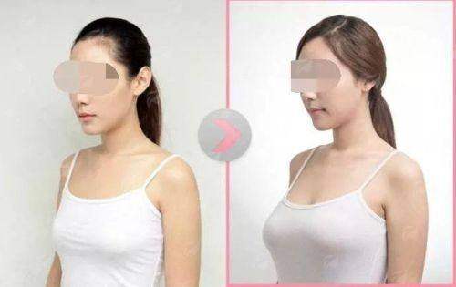 三、在连云港媚眼整形做假体隆胸有哪些独特优势?