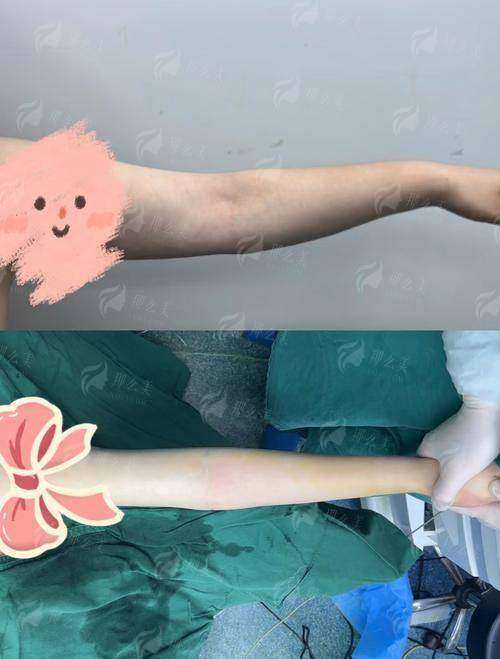 四、如何预约连云港媚眼整形的手臂环吸项目?