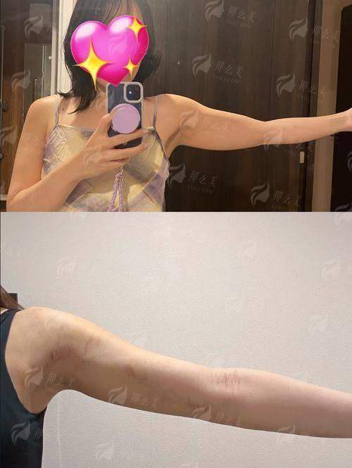 三、手臂环吸手术需要注意哪些问题?