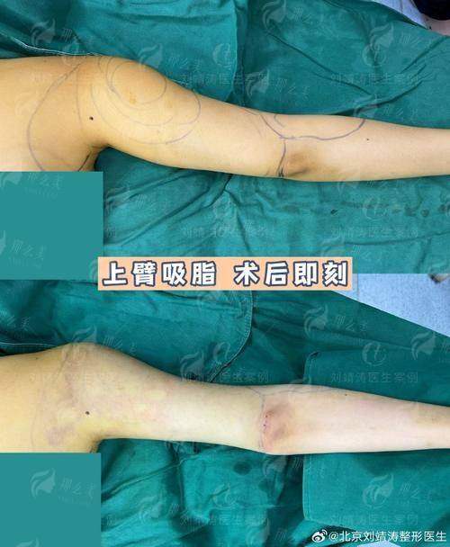 拜拜肉克星来了！连云港媚眼整形手臂环吸无痕技术全解析