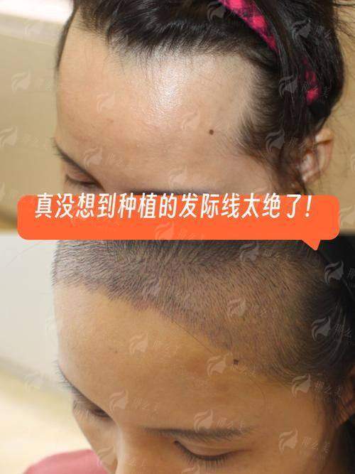 二、扬州大麦植发做发际线密度调整有何特色？