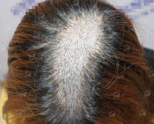 三、在扬州大麦植发做发际线种植要避开哪些坑？