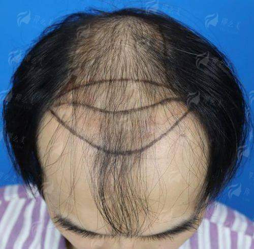 二、河南郑州华仁植发的医生团队实力如何?