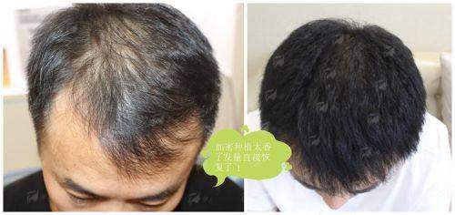 三、细软发质必看！刘裴华医生在郑州华仁植发的特殊方案