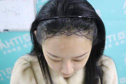 二、郑州华仁植发价格贵不贵？刘裴华医生收费明细大公开