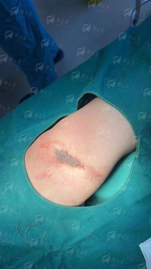 二、潮州韩美医疗美容医院的胎记治疗技术好吗？