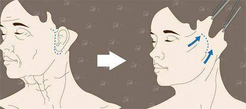 <strong>二、珠海韩妃医疗美容门诊部余传伟轮廓整形技术特色</strong>