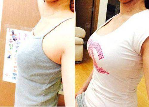 三、扬州美贝尔整形医院的胸部整形有哪些优势？