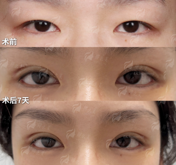 <strong style="color:red;">二、珠海韩妃医疗美容门诊部双眼皮技术特色</strong>