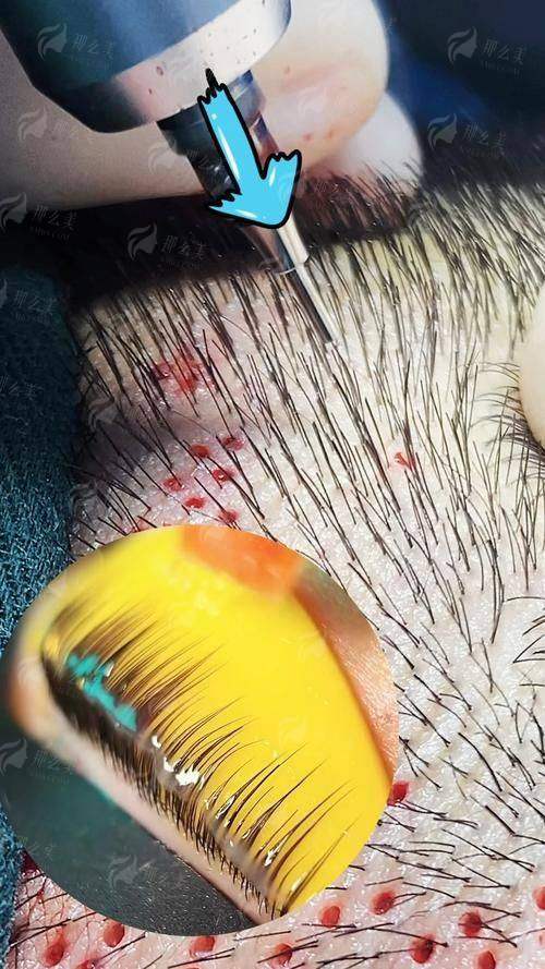 祁强在苏州名仕医院植发中心的眉毛种植技术超棒，价格揭秘，新颜智尚可预约体验！