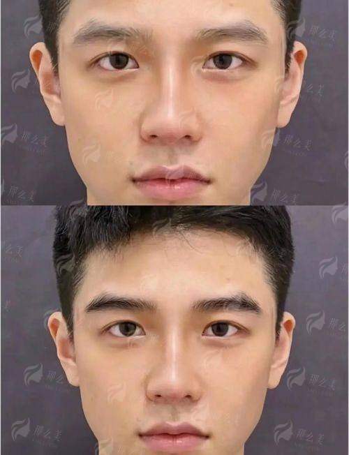 四、苏州名仕医院植发中 心祁强眉毛种植怎么预约？价格贵不贵？