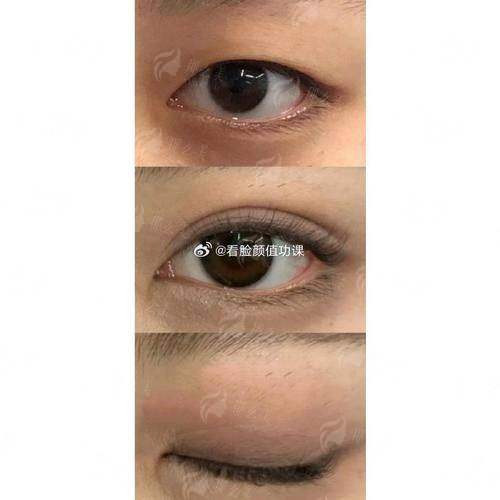 邯郸双眼皮哪家好？京美vs现代丽人真实案例对比，附价格分析！