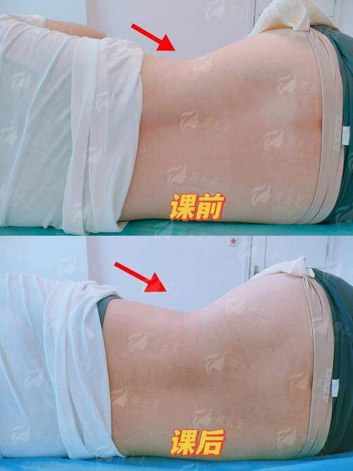 三、洛阳臻颜腰腹吸脂的价格和修复期要多久？