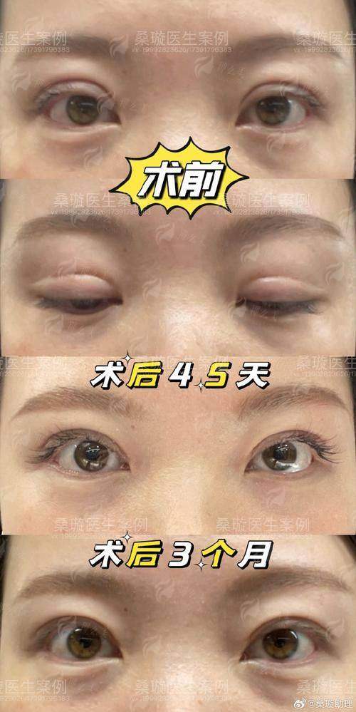 二、广东韩妃李猷双眼皮核心技术优势