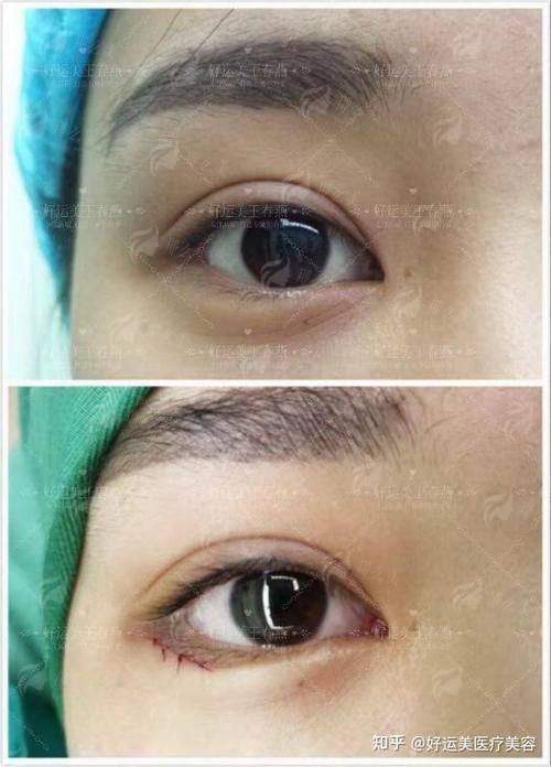 二、广东韩妃整形外科医院：技术风格与自然度解析