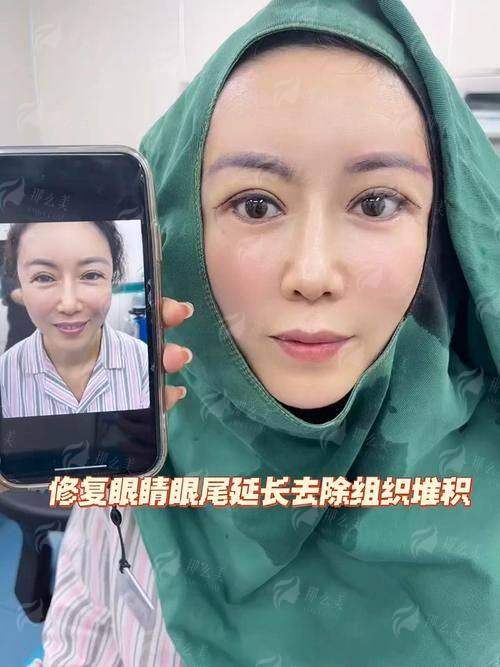 广东韩妃李光琴和纪春华双眼皮谁最自然？医生特色技术全公开，速来预约挂号！