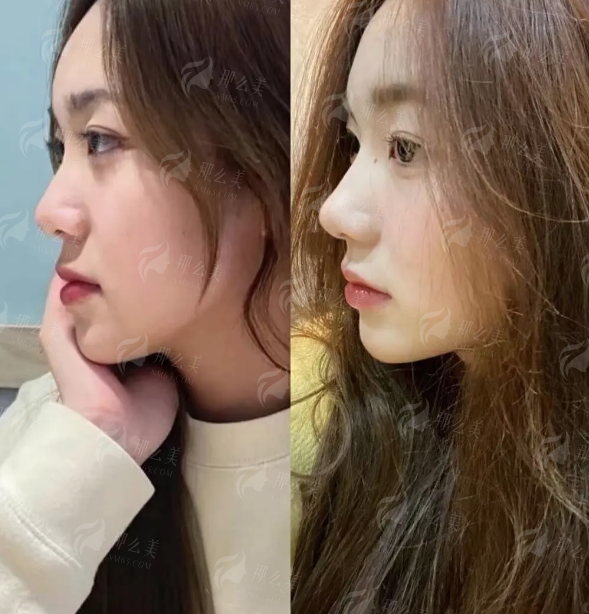 四、如何预约广州高尚的黄金龙隆鼻？