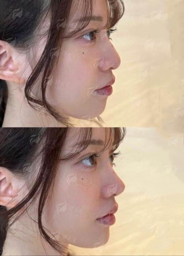 广州高尚医院黄金龙隆鼻，特色技术大公开，点击预约获取价格优惠攻略！