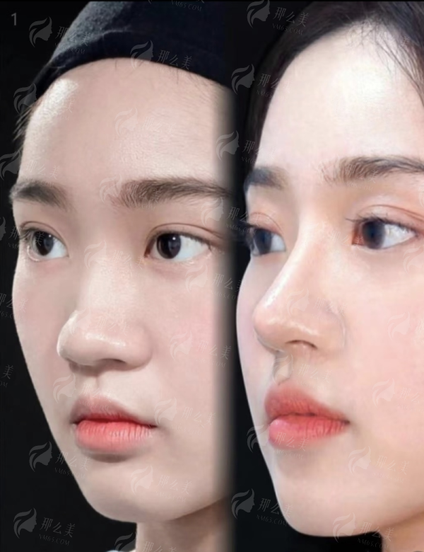 二、广州高尚做黄金龙隆鼻的医生团队怎么样？