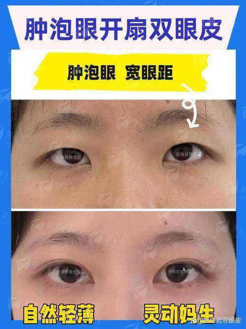 二、上海韩卓医疗美容的祛眼袋技术优势是什么？