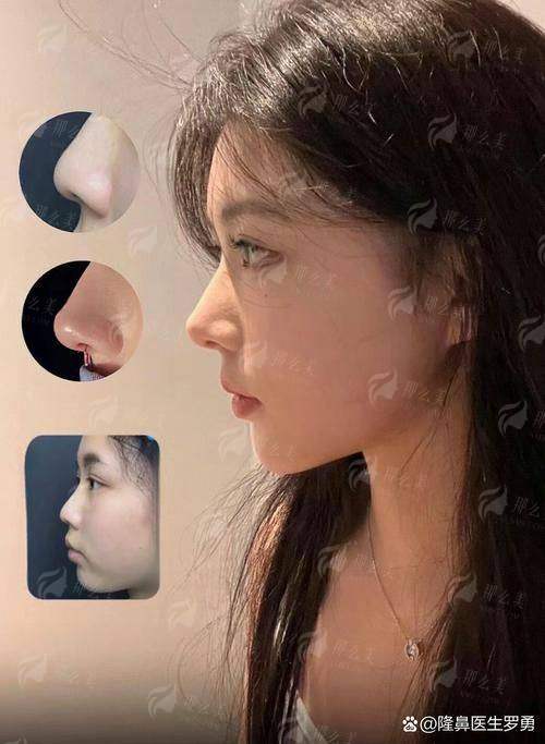 二、福州靓壹生膨体隆鼻适合哪些人做？