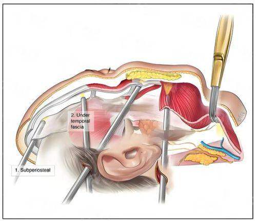 二、乌鲁木齐慧美的拉皮手术有哪些优势?