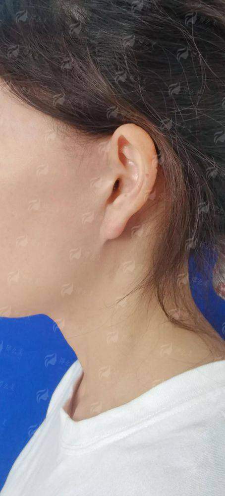 三、乌鲁木齐慧美的拉皮手术适合哪些人?