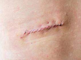 深圳鹏程疤痕科专业修复剖腹产/烧伤疤痕，特色技术+成功案例，点击预约了解价格