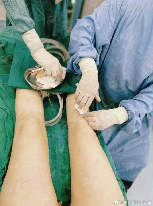 想吸脂？广西柳州华美别错过！含案例推荐，一键预约享价格优惠，还有特色技术等你了解