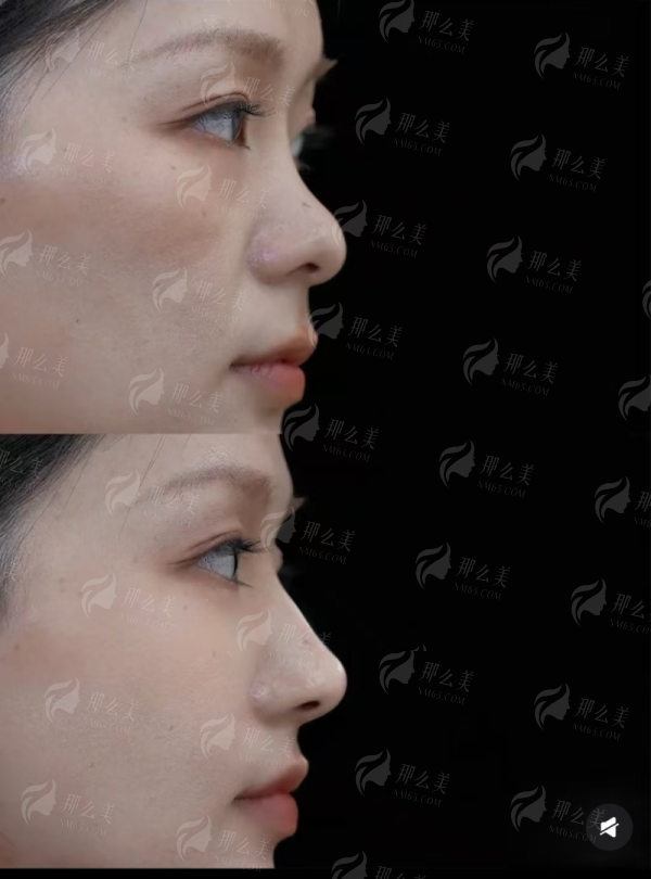 四、怎么预约福州靓壹生膨体隆鼻？