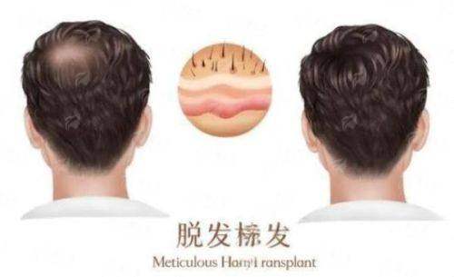 三、北京碧莲盛植发发际线种植价格全解析