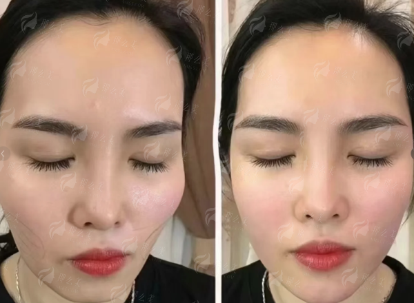 一、重庆长良医疗美容的李敏医生光影轻龄术是什么？